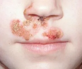 Impetigo este ceea ce este