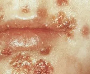 Impetigo este ceea ce este