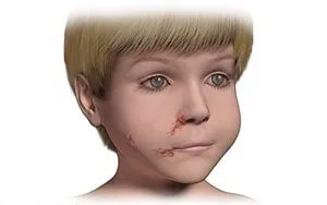 Impetigo este ceea ce este Impetigo este ceea ce este