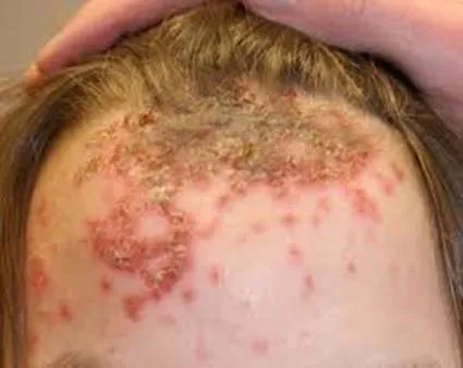 Impetigo este ceea ce este