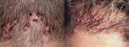 Impetigo este ceea ce este Impetigo este ceea ce este
