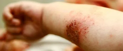 Impetigo este ceea ce este Impetigo este ceea ce este