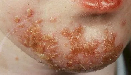 Impetigo este ceea ce este Impetigo este ceea ce este