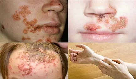 Impetigo este ceea ce este Impetigo este ceea ce este