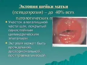 Eroziunea, care face parte din ceea ce