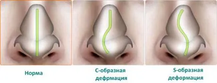 Sforăitul este ce să facă Sforăitul este ce să facă