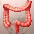 Cum pot curata intestinele de toxine Cum pot curata intestinele de toxine