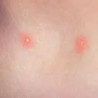 De unde știi că aveți varicela De unde știi că aveți varicela