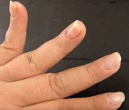 Cum de a elimina unghiile cu gel Naroscheny Cum de a elimina unghiile cu gel Naroscheny
