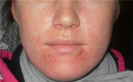 eczeme tratament facial