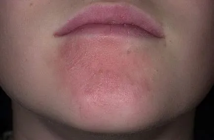 eczeme tratament facial
