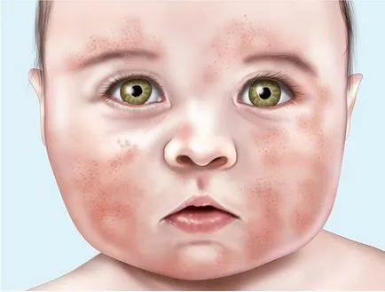 eczeme tratament facial