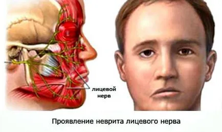 Cum nervii sunt tratate Cum nervii sunt tratate