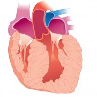 cardiomegaliei-l