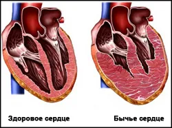 cardiomegaliei-l