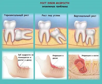De ce cresc un dinte înțelepciune