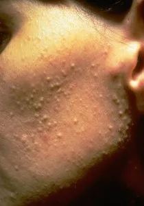 acnee produse cosmetice