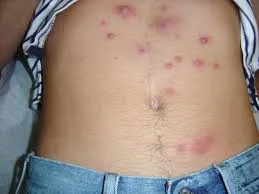Ce este Corynebacterium