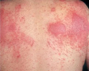 Preparate pentru tratamentul dermatitei