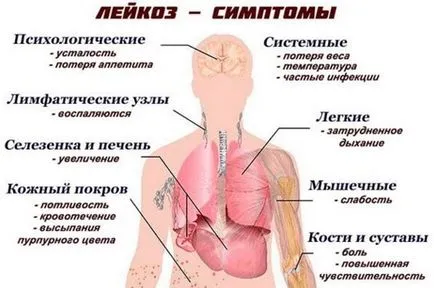 Ce este boala de leucemie
