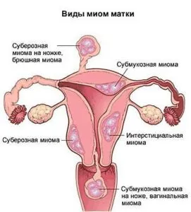Ce se va întâmpla dacă există fibroame