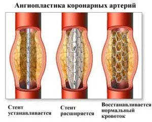 Operațiunea după un atac de cord