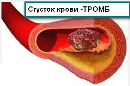 trombi De ce detașat trombi De ce detașat