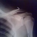 Ce este o fractura de clavicula