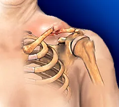 Ce este o fractura de clavicula Ce este o fractura de clavicula