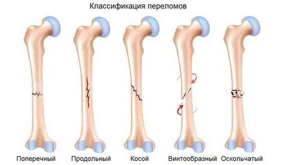 Ce este o fractura de clavicula Ce este o fractura de clavicula