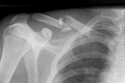 Ce este o fractura de clavicula
