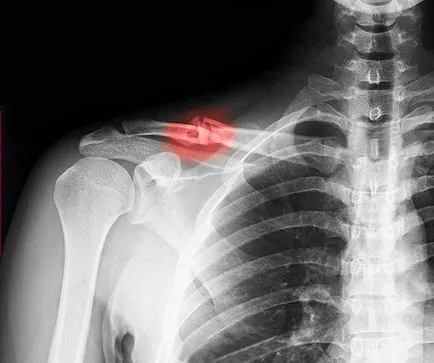 Ce este o fractura de clavicula Ce este o fractura de clavicula