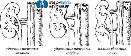 Care este dublarea parțială a rinichilor