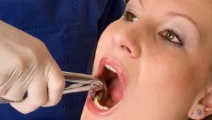 Ce trebuie să fac pentru a elimina un dinte doare Ce trebuie să fac pentru a elimina un dinte doare