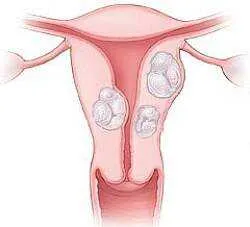 Ce se va întâmpla dacă există fibroame Ce se va întâmpla dacă există fibroame