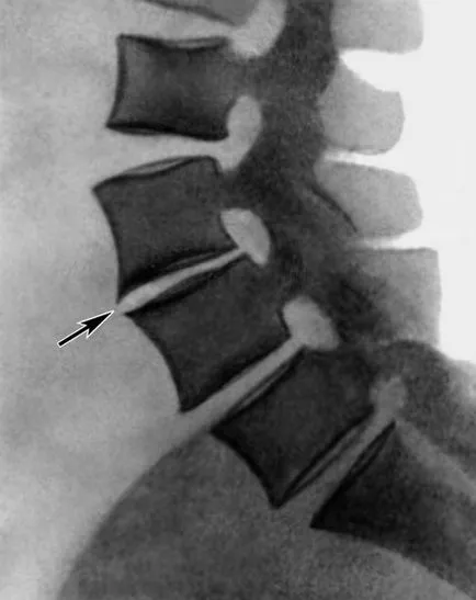 Ce este osteocondrozei comun