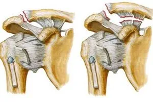 Pentru tratamentul rupturile de ligament Pentru tratamentul rupturile de ligament