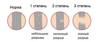 Pentru tratamentul rupturile de ligament