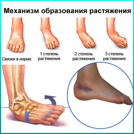 Pentru tratamentul rupturile de ligament Pentru tratamentul rupturile de ligament