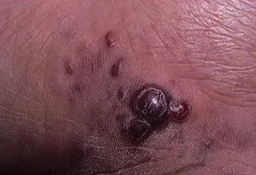 sarcomul Kaposi ce este sarcomul Kaposi ce este