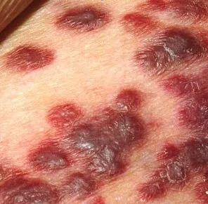 sarcomul Kaposi ce este sarcomul Kaposi ce este