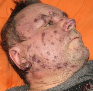 sarcomul Kaposi ce este sarcomul Kaposi ce este