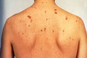 sarcomul Kaposi ce este sarcomul Kaposi ce este