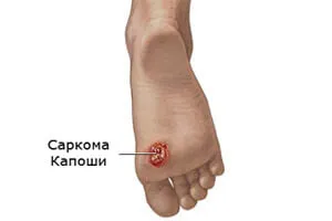 sarcomul Kaposi ce este sarcomul Kaposi ce este
