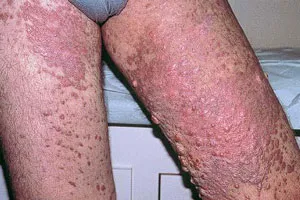 sarcomul Kaposi ce este sarcomul Kaposi ce este