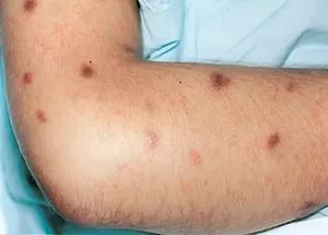 sarcomul Kaposi ce este sarcomul Kaposi ce este