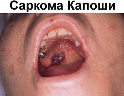 sarcomul Kaposi ce este