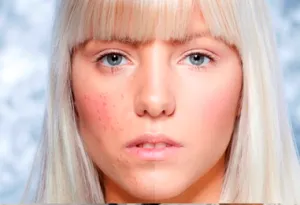 Dermatitei ce să facă Dermatitei ce să facă