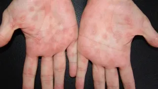 Diagnosticul de sifilis