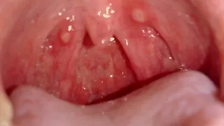 Diagnosticul de sifilis